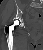 Failed hip replacement,CT scan