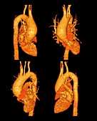 Narrowed aorta,3D CT scans