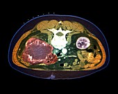 Kidney tumour,CT scan