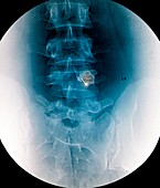 Back pain treatment,X-ray