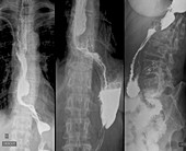 Throat cancer,X-rays