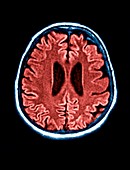 Creutzfeldt-Jakob disease,MRI scan