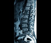 Secondary spinal cancer,MRI scan