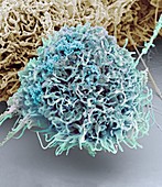 Vaginal cancer cell,SEM