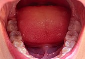 Child's molars and tongue