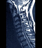 Forestier's disease,MRI scan