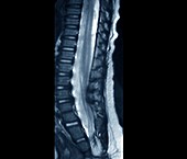 Fibrolipoma of the spine,MRI scan