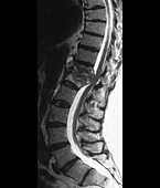Tuberculosis of the spine,MRI scan