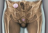 Incontinence implant,X-ray