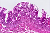 Gastritis,light micrograph
