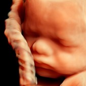 32 week foetus,3-D ultrasound scan