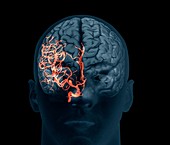 Brain aneurysm,3D scan