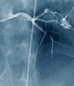 Coronary stenosis before treatment,X-ray