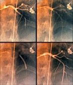 Coronary stenosis treatment,X-rays