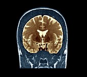 Thickened skull,MRI scan