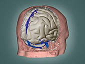 Thrombophlebitis in the brain,3D CT scan