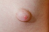 Gynaecomastia,male breast