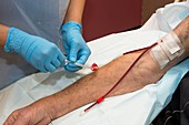 Haemodialysis: cannula in arm