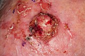 Squamous skin cancer on the scalp