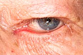 Ectropion (drooping) of the eyelid