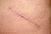 Scar after hip replacement surgery