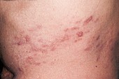 Resolving shingles rash
