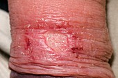 Herpes infection on the penis