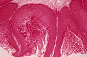Cervical wart,light micrograph