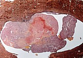 Endometrial cancer,light micrograph