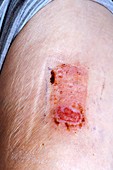 Skin graft site on the arm