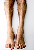 Claw foot in Charcot-Marie-Tooth disease