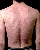 Body rash caused by antibiotic drug
