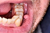 Fibroma in the mouth