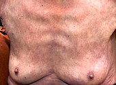 Psoriasis on breast after treatment