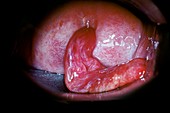 Cervical polyp,endoscope view