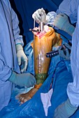 Knee replacement surgery