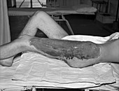 Penicillin drug treatment,World War II