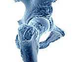 Hip,3D bone reconstruction from MRI Data