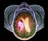 Stroke,MRI and 3D CT scans
