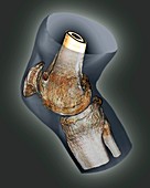 Arthritis of the knee,3D CT scan