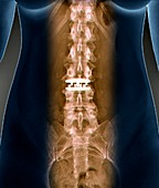 Artificial spinal disc,X-ray