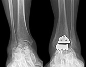 Replacement ankle joint,X-ray