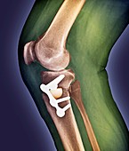 Knee realignment surgery,X-ray