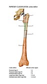 Paprosky femur defect classification