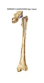 Paprosky femur defect,type I lateral