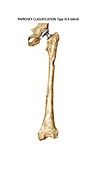 Paprosky femur defect,type IIIA lateral