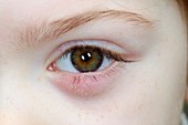 Chalazion in the lower eyelid