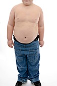 Obesity in a young boy