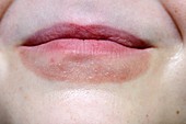 Lip smacking dermatitis