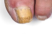 Fungal toenail infection
